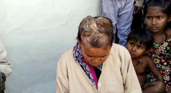 The strange case of the woman in India who is growing horns on her head