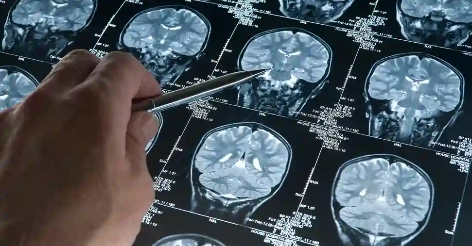 U.S. Approves Breakthrough Drug for Alzheimer's Disease 2 Leqembi is from pharmaceutical companies Eisai, Tokyo, and Biogen, Cambridge, USA (Getty Images).