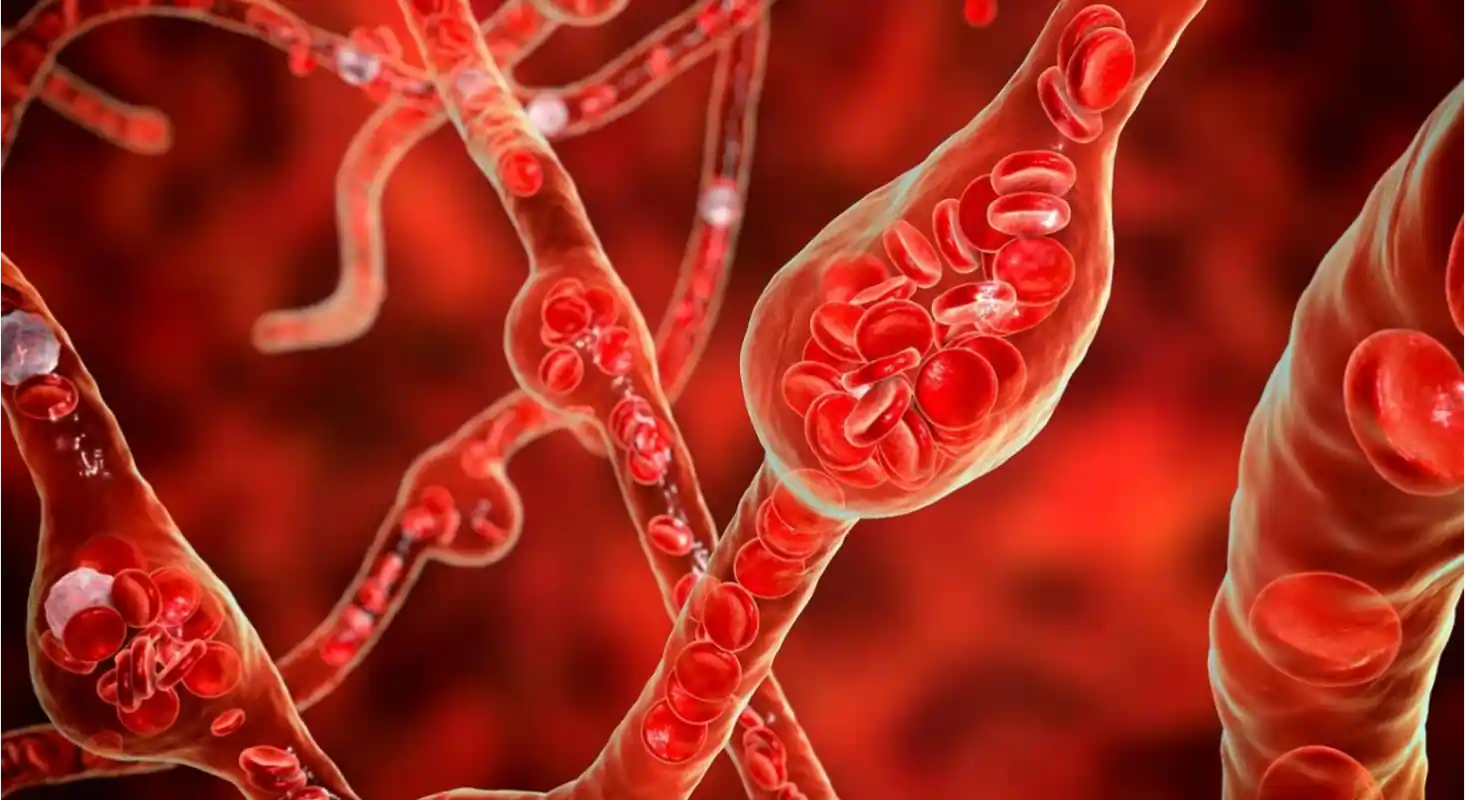 Understanding Aneurysms: Risk Factors and Dangers 1 This is what the ballooning of an artery due to an aneurysm looks like